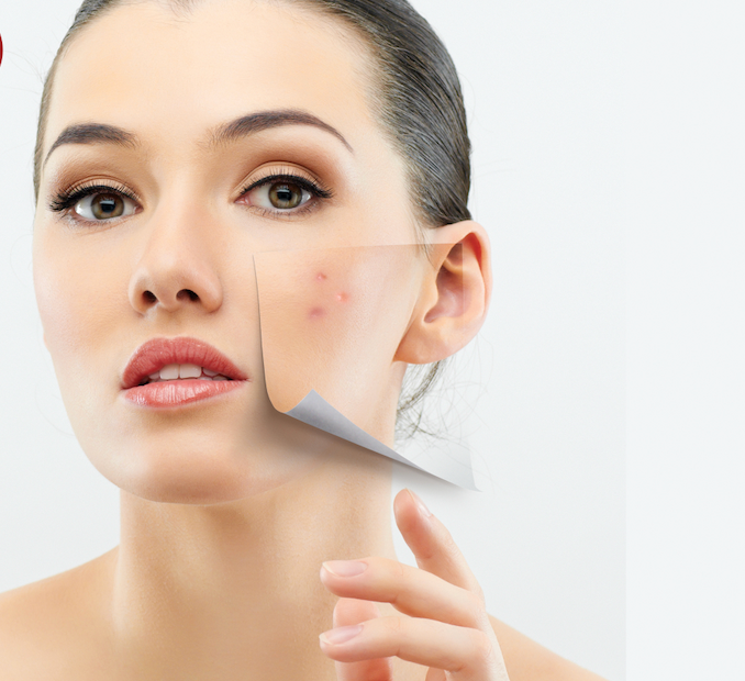 Acne Care Treatment